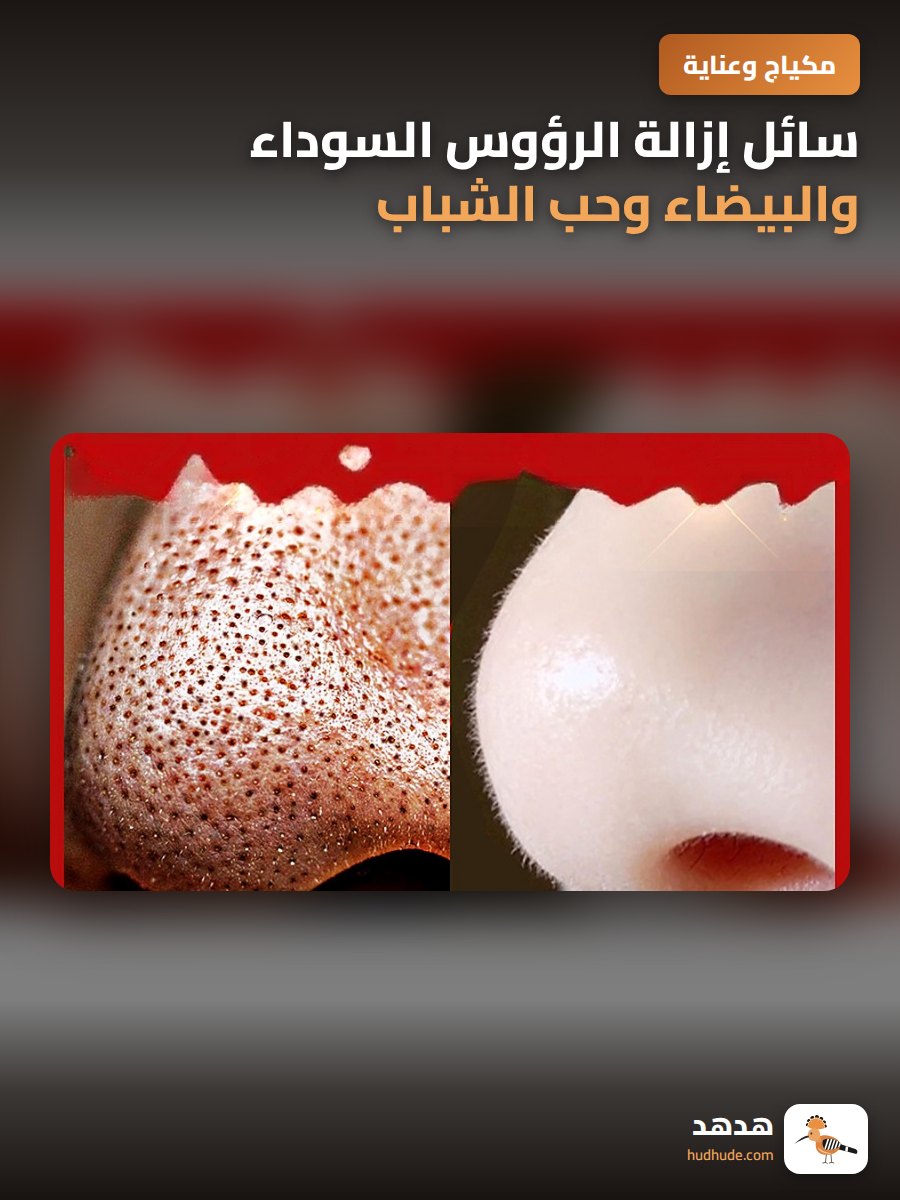 سائل إزالة الرؤوس السوداء والبيضاء وحب الشباب بخلاصة الفواكه للعناية بالبشرة
